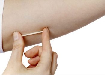 Deri Altı Çubuk Nedir? Hamileliği Engellemek için İmplant Kullanımı