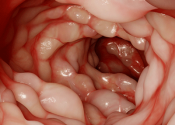 Crohn Hastalığı Nedir? Belirtileri ve Tedavisi