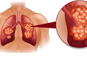 Akciğer Kanseri Belirtileri ve Tedavisi