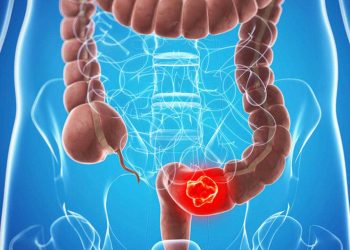 Kolon (Bağırsak) Kanseri Nedir ? Tedavisi Nasıl Olur ?