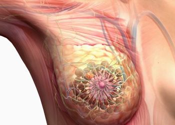 Meme Kanseri Evreleri ve Tedavisi