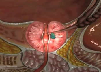 Prostat Kanseri Belirtileri Nelerdir?Teşhisi ve Tedavisi
