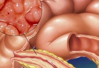 Ülseratif Kolit Nedir? Tedavisi Var Mıdır?